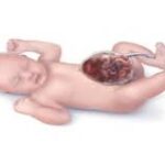ناهنجاری های مادرزادی اندام تناسلی