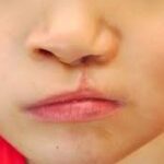 ناهنجاری های مادرزادی در ایران (بروز رسانی شده)